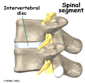 How a Herniated Disc Causes Pain in the Extremities
