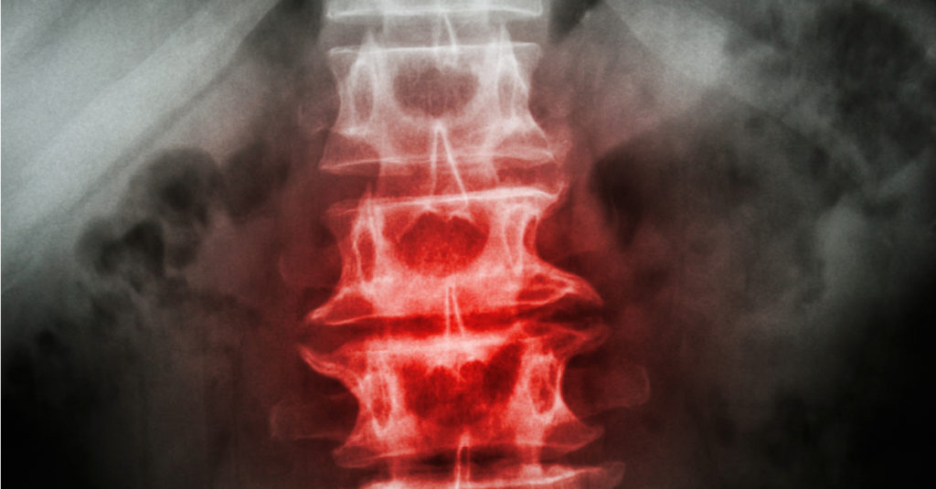 What is Spondylolisthesis and How Is It Treated?